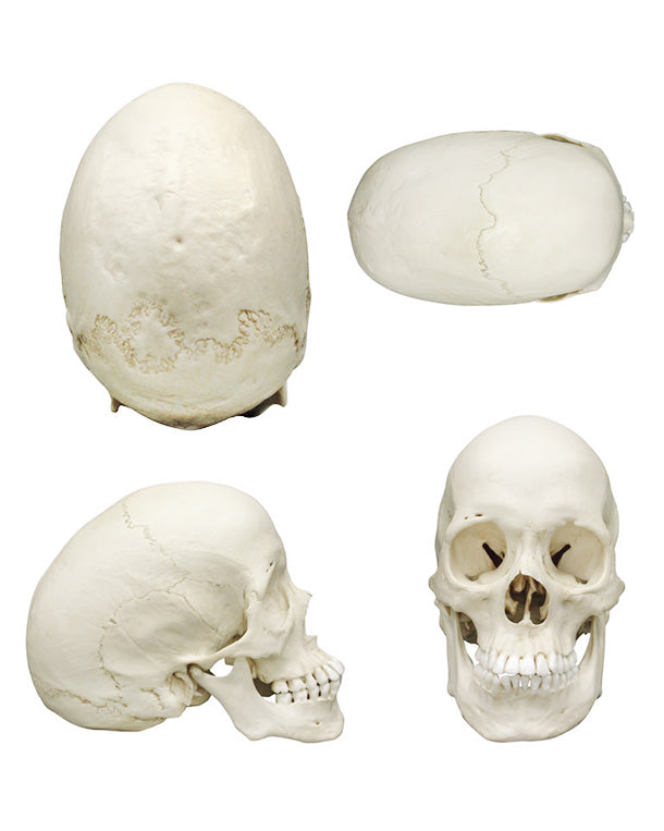 Replica Scaphocephalic Skull